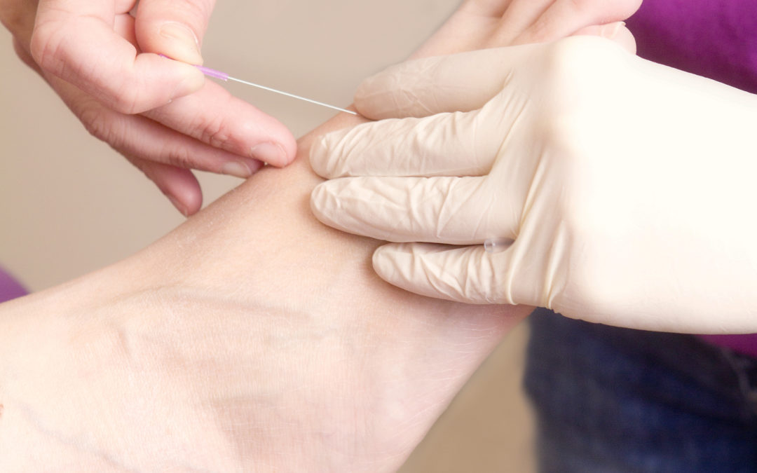 Dry Needling voor podotherapie